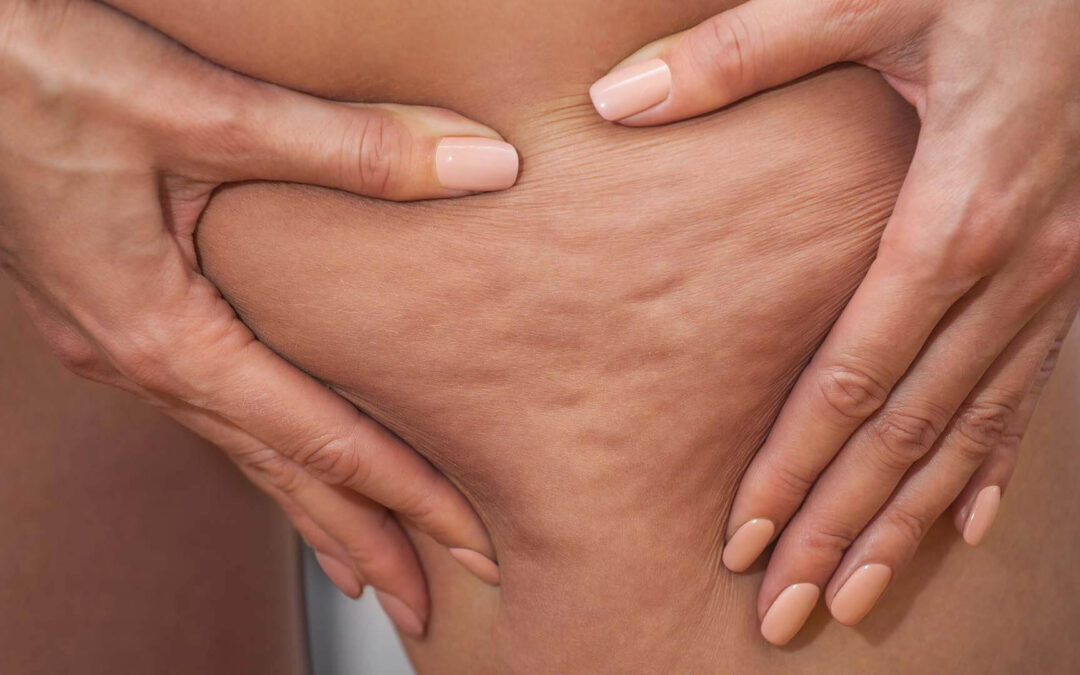 Word fit met deze 10 anti-cellulite tips