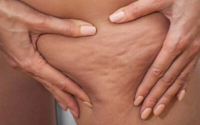 Word fit met deze 10 anti-cellulite tips
